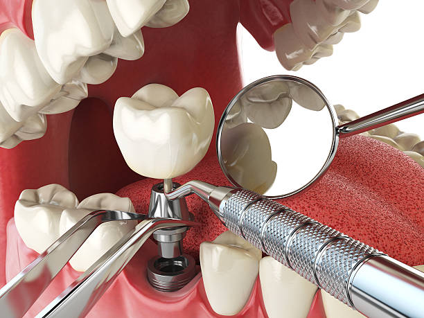 Best Emergency Root Canal Treatment in Forsyth, IL